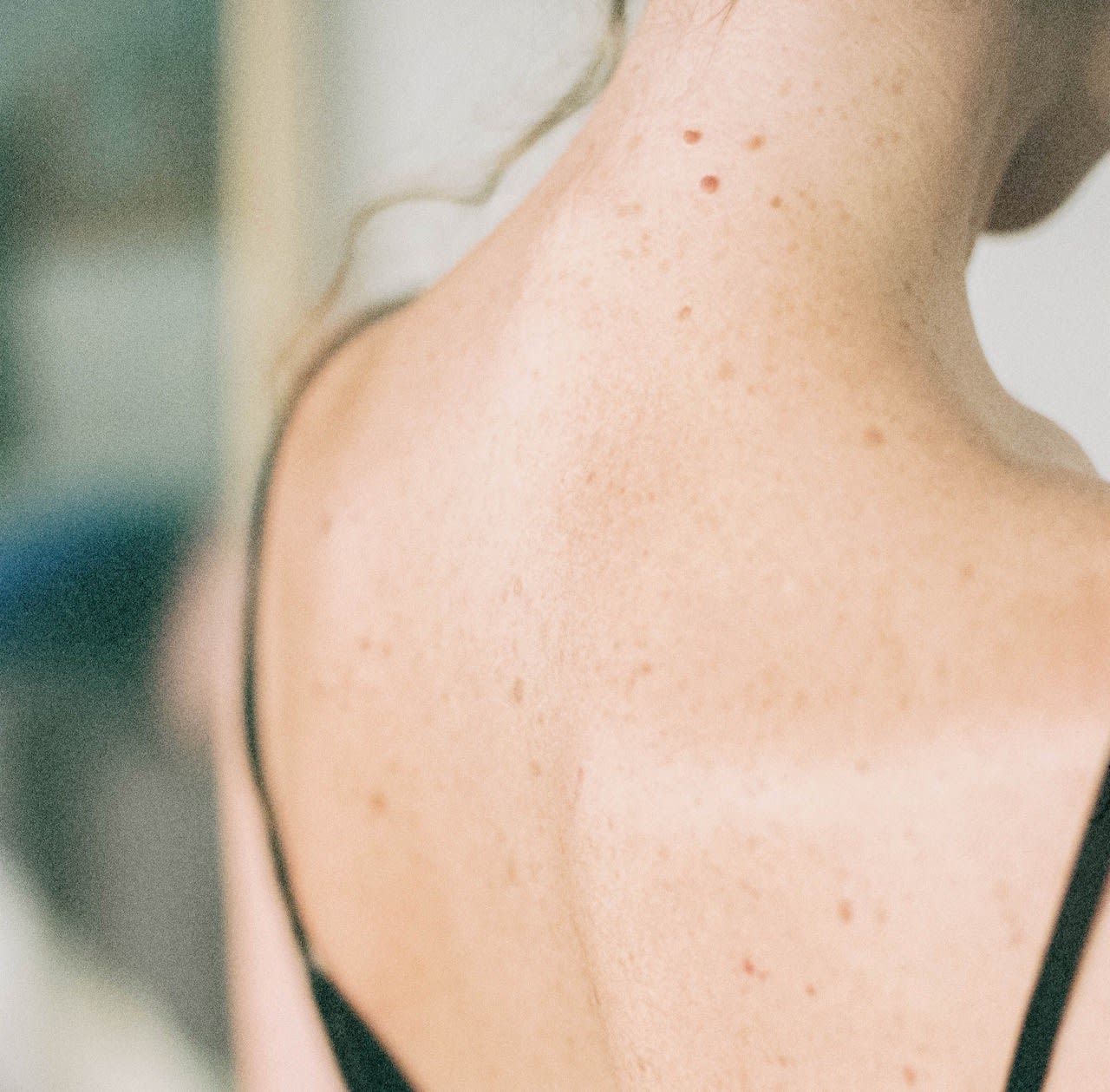 Get rid of dark spots, body acne,stretch marks hyperpigmentation, une