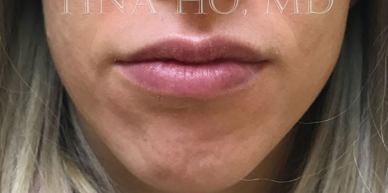 Lip Augmentation and Injections After, Female 30 - 1694