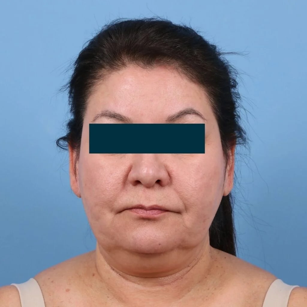 Facelift Before, Female 44 - 3461