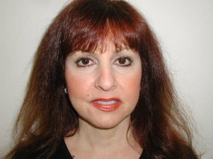 Facelift After, Female 62 - 4204