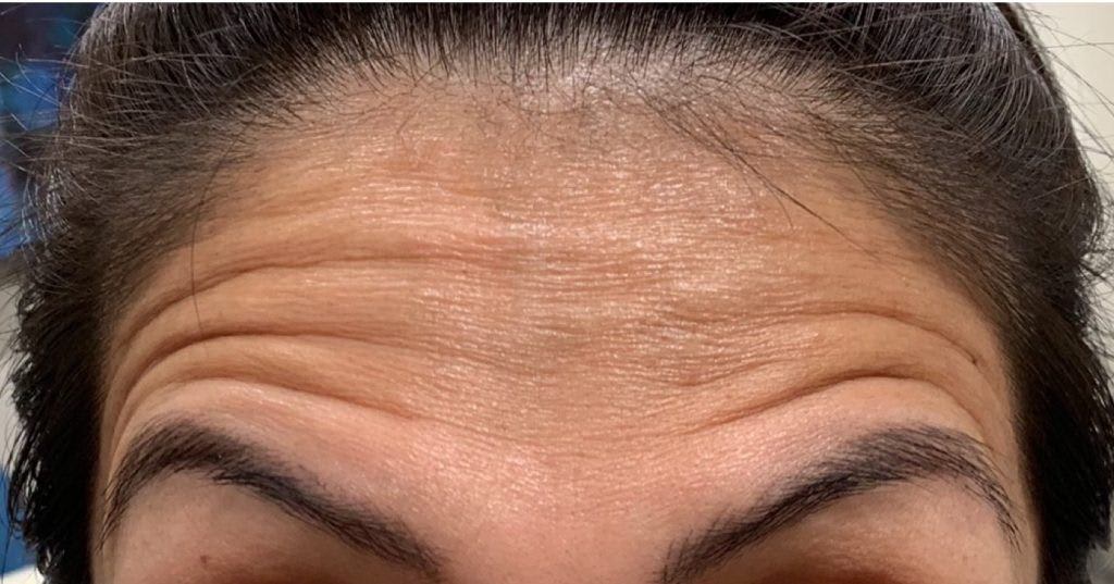 Botox Before, Female 36 - 1305
