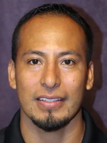 Rhinoplasty After, Male 35 - 4511