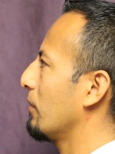 Rhinoplasty Before, Male 35 - 4512