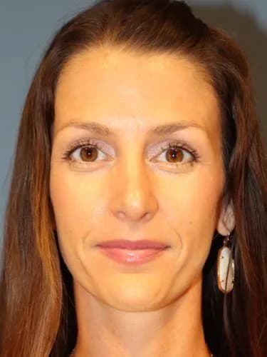 Rhinoplasty After, Female 32 - 4510