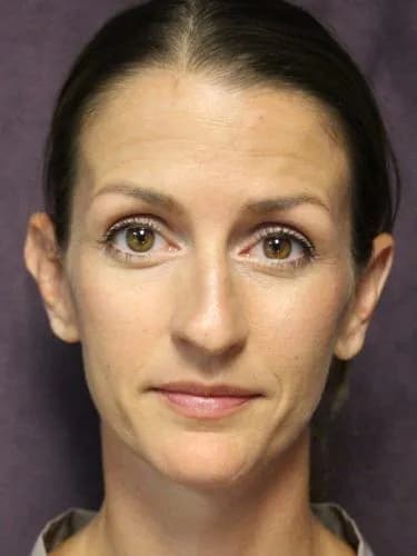 Rhinoplasty Before, Female 32 - 4510