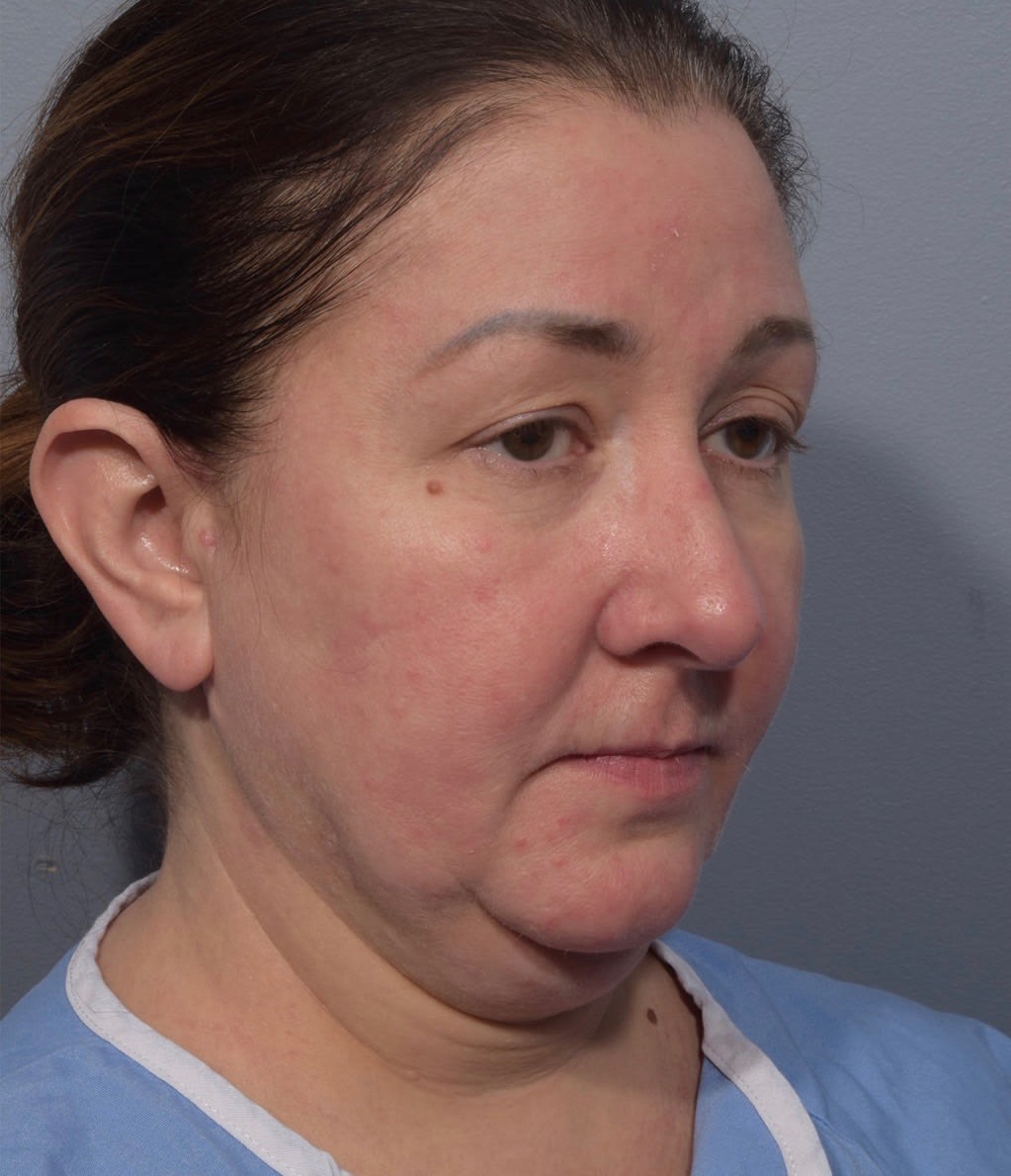 Facial Skin Firming & Lifting Solutions Before, Female 46 - 1464