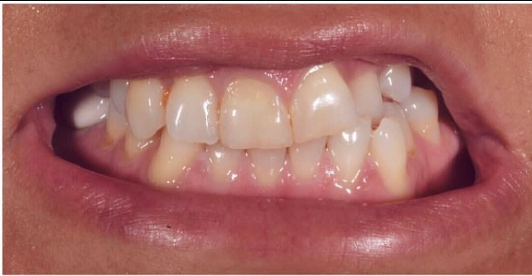 Dental Veneers Before, Female 30 - 179