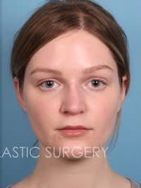 Brow Lift After, Female 36 - 1898