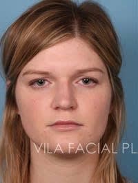 Brow Lift Before, Female 36 - 1898
