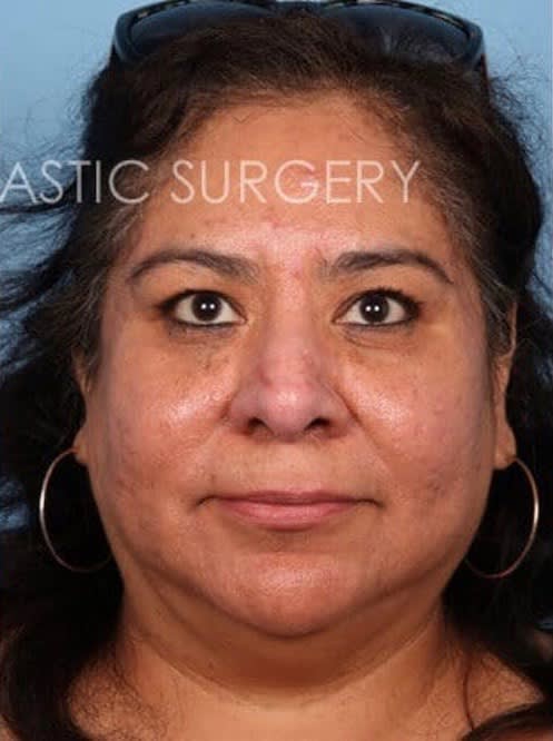 Nose Bump Solutions After, Female 48 - 1901