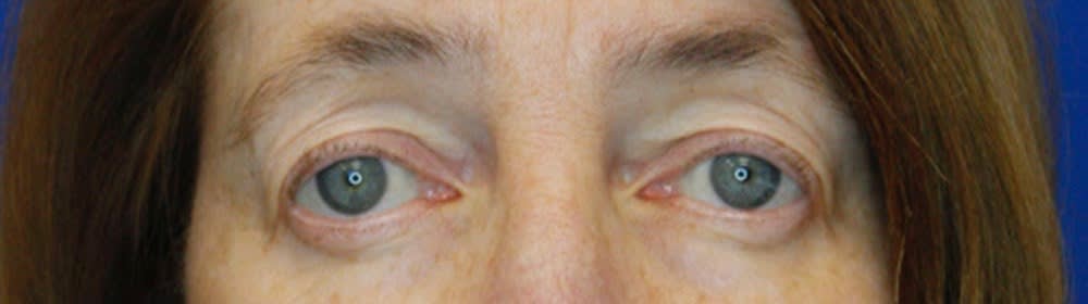 Blepharoplasty After, Female 58 - 1899