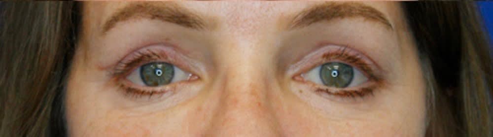 Blepharoplasty After, Female 56 - 1900