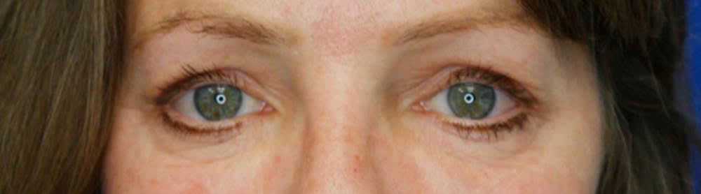 Blepharoplasty Before, Female 56 - 1900