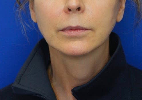 Facelift After, Female 59 - 1897