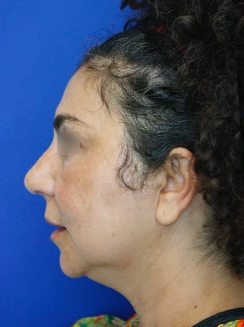 Rhinoplasty After, Female 56 - 1891