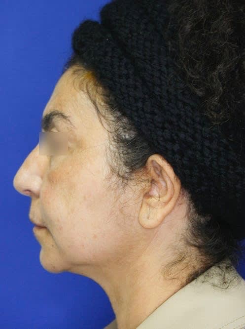 Rhinoplasty Before, Female 56 - 1891