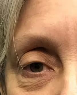 Blepharoplasty Before, Female 41 - 4235