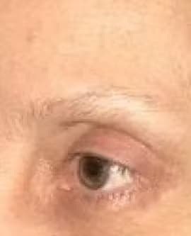 Blepharoplasty After, Female 41 - 4237