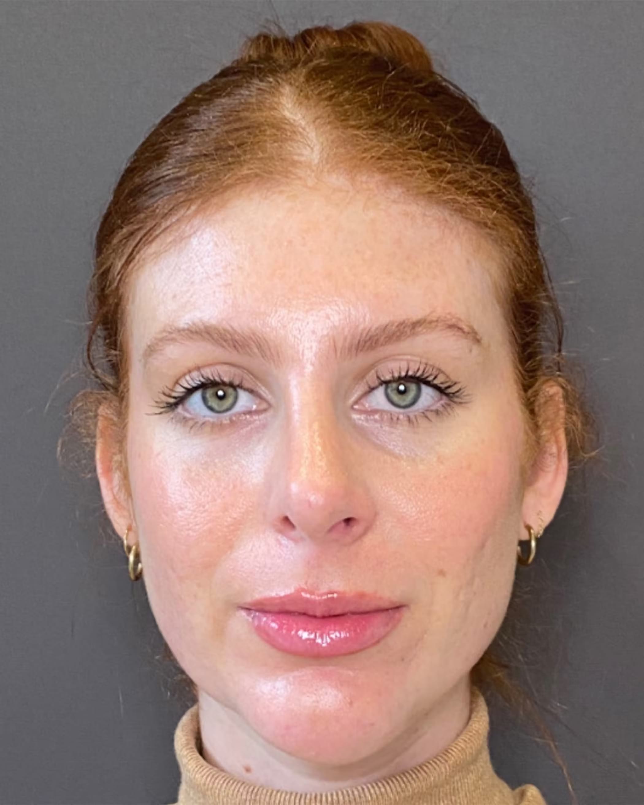 Chin Augmentation After, Female 29 - 4228