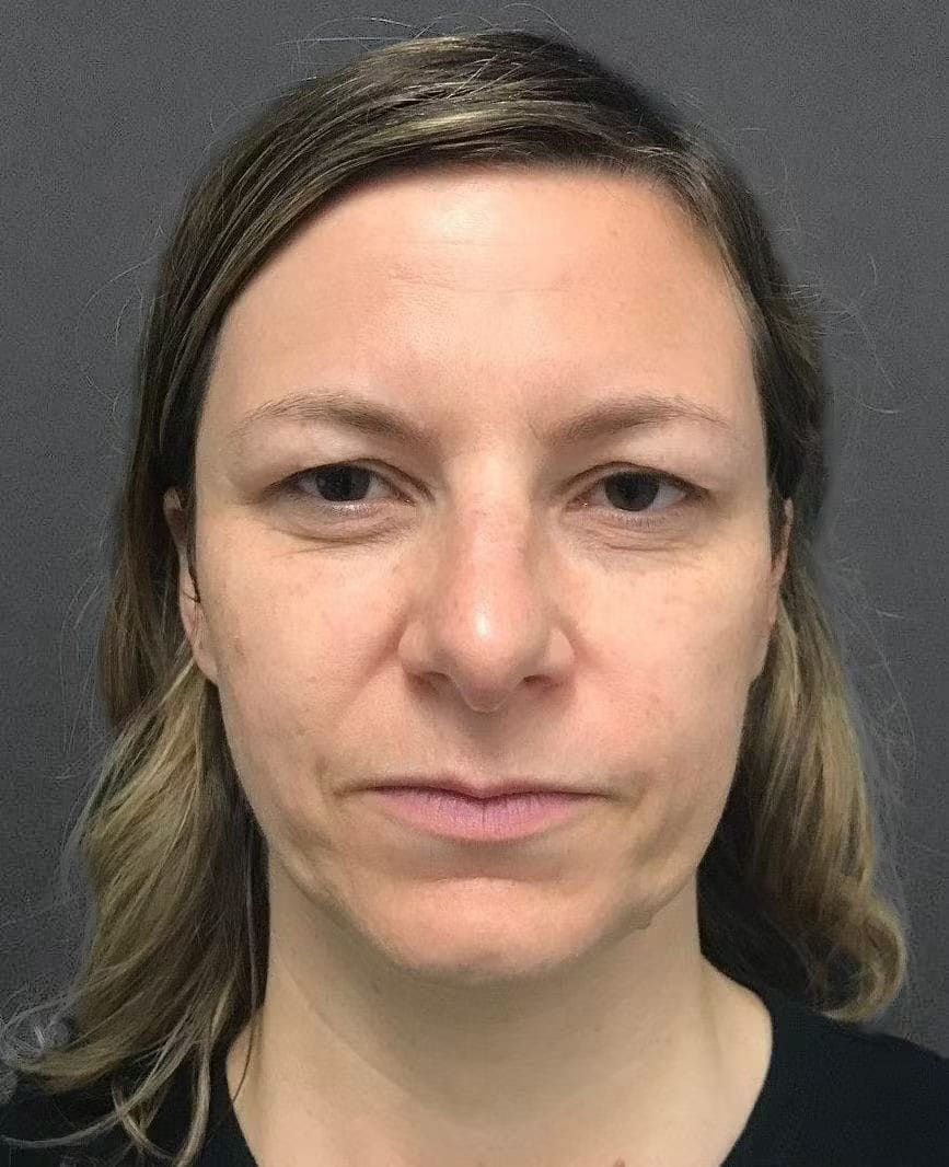 Blepharoplasty Before, Female 33 - 4230