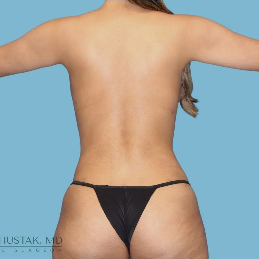 Brazilian Butt Lift After, Female 26 - 4506