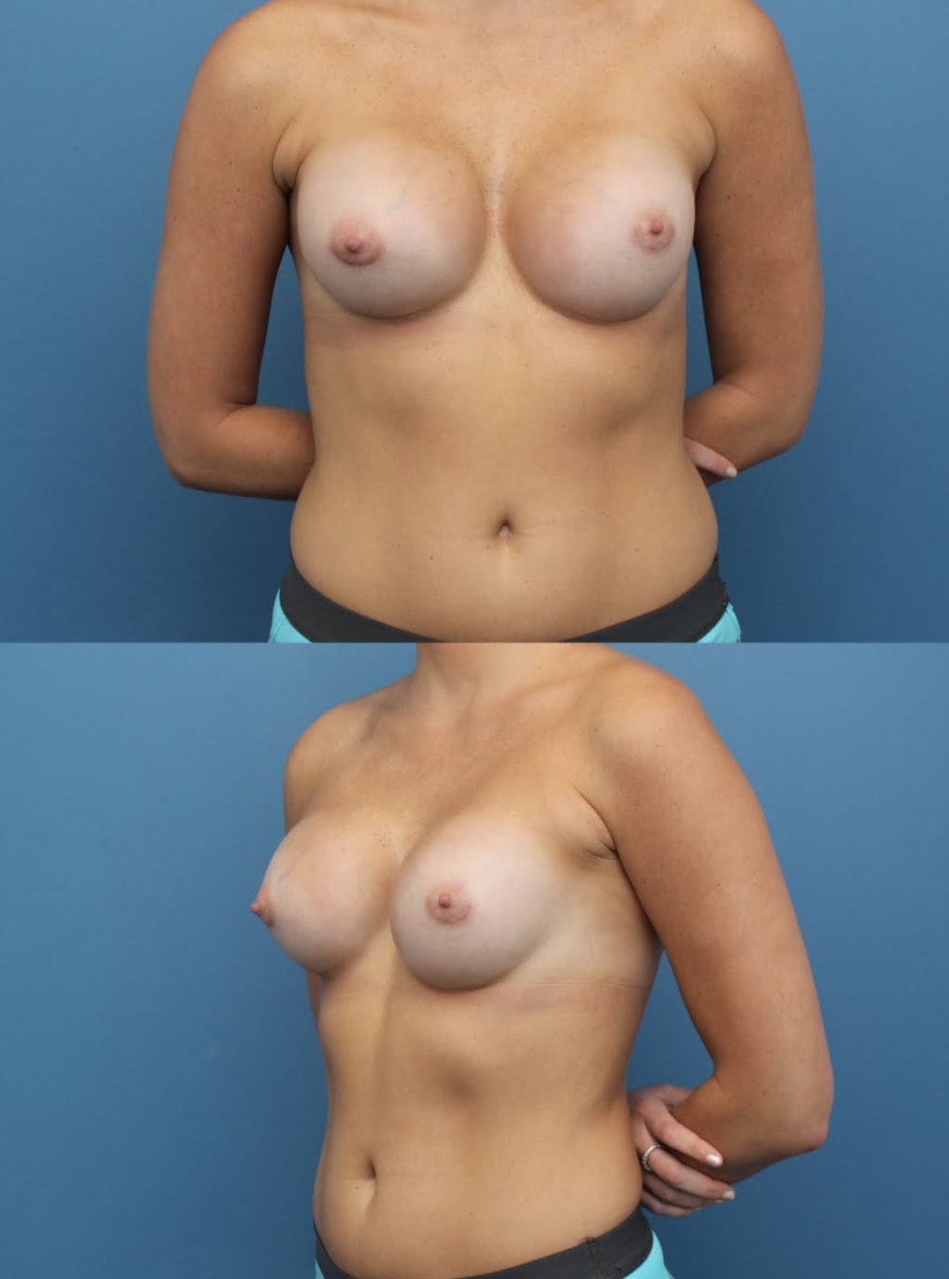 Breast Augmentation (Augmentation Mammaplasty) After, Female 26 - 1391