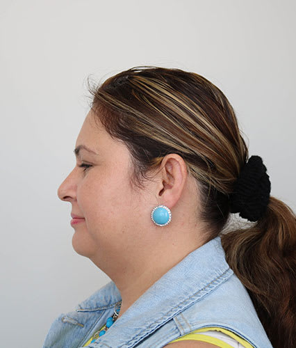 Submental Liposuction Before, Female 51 - 3463