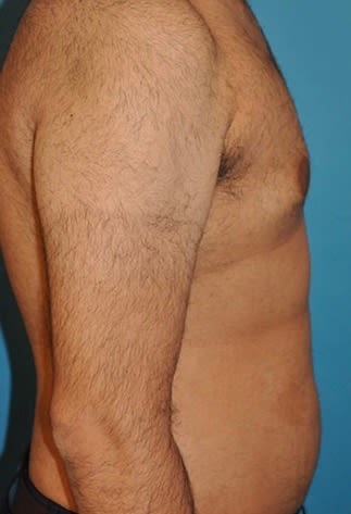 Male Breast Reduction (Gynecomastia Surgery) After, Male 39 - 2166