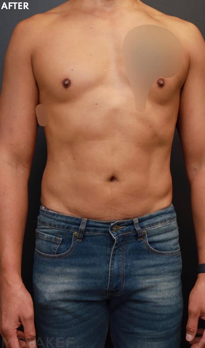 Liposuction After, Male 37 - 1927