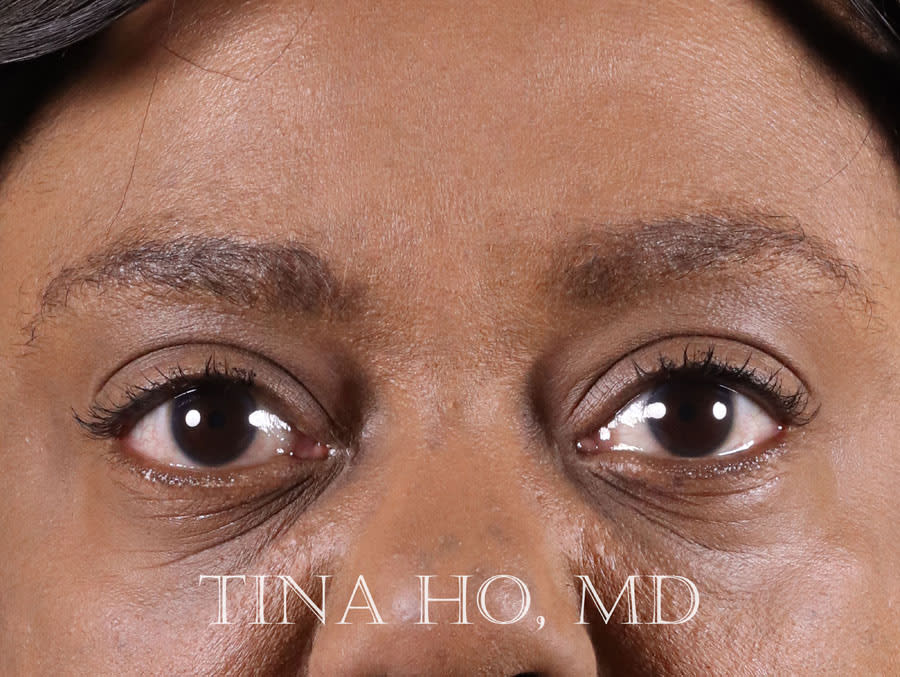 Dermal Fillers & Injectables After, Female 38 - 1688
