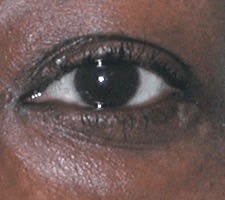 Blepharoplasty Before, Female 60 - 3439