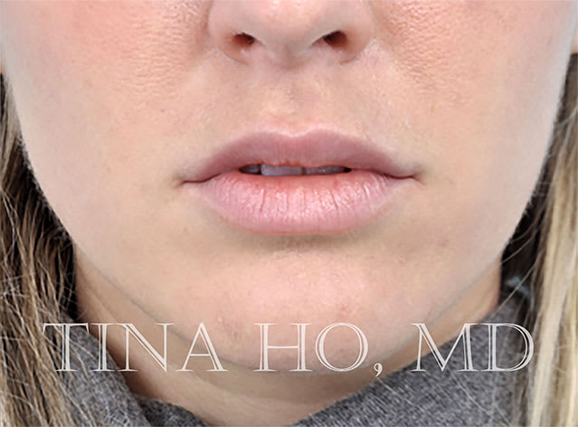 Lip Augmentation and Injections After, Female 27 - 1696