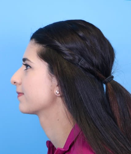 Rhinoplasty Before, Female 29 - 2351