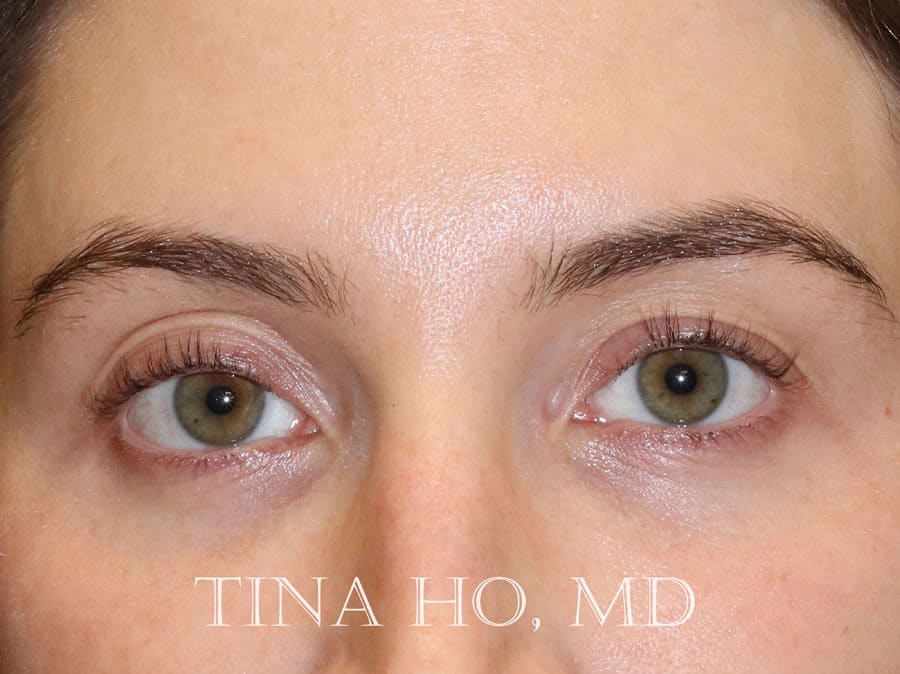 Dermal Fillers & Injectables After, Female 30 - 1689