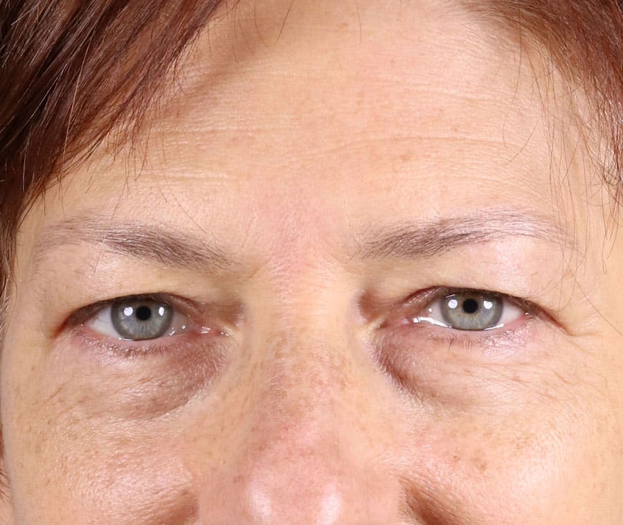 Dermal Fillers & Injectables Before, Female 44 - 1690