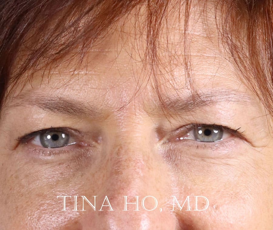 Dermal Fillers & Injectables After, Female 44 - 1690