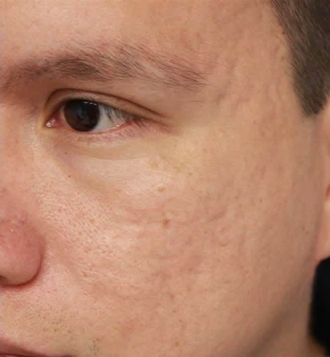 Acne Scar Solutions After, Male 29 - 2336