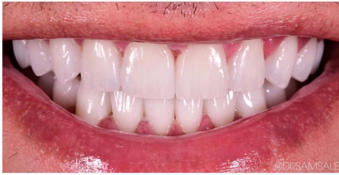Dental Veneers After, Male 35 - 165