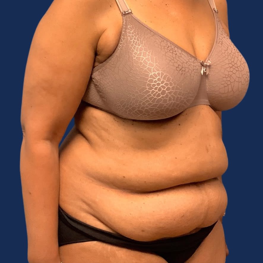 Tummy Tuck (Abdominoplasty) Before, Female 68 - 3596