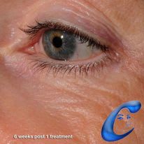 Eye Rejuvenation Solutions After, Female 56 - 3968