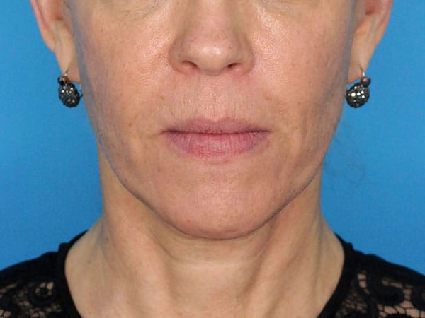 Laser Skin Resurfacing Before, Female 50 - 1699