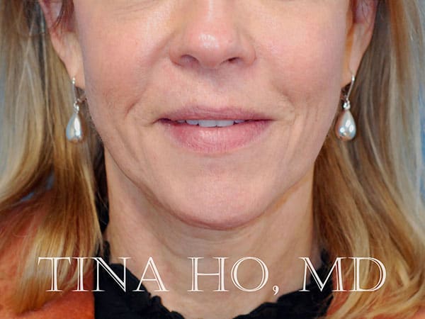 Laser Skin Resurfacing After, Female 50 - 1699