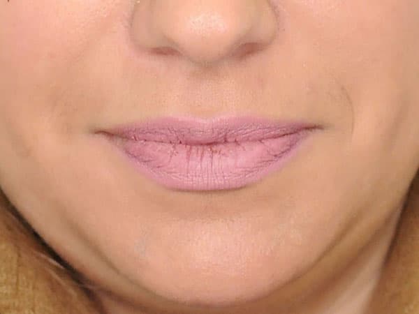 Lip Augmentation and Injections Before, Female 34 - 1695