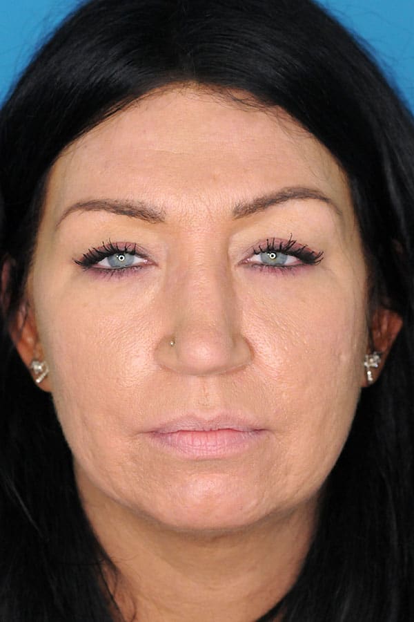 Lip Augmentation and Injections Before, Female 44 - 1692
