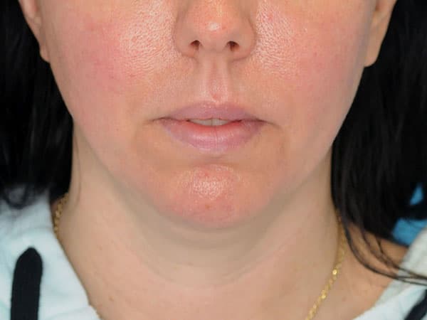 Jawline Slimming with Botox Before, Female 36 - 1697