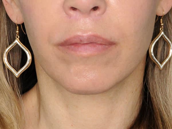 Lip Augmentation and Injections Before, Female 53 - 1693