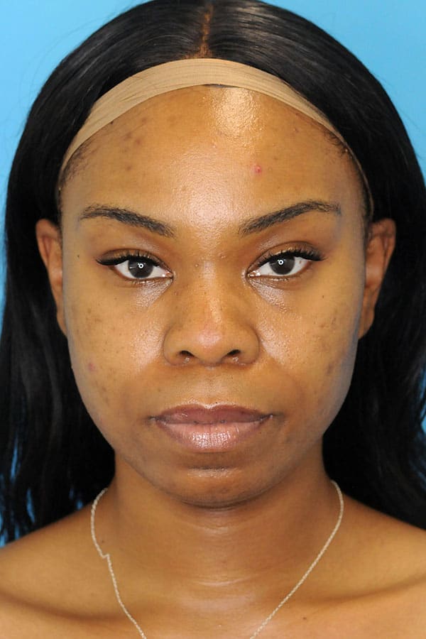 Cheek Augmentation with Fillers Before, Female 35 - 1691