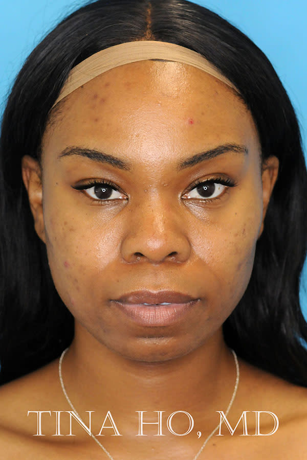 Cheek Augmentation with Fillers After, Female 35 - 1691