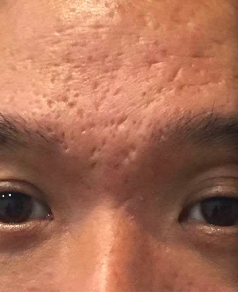 Acne Scar Solutions Before, Male 26 - 2338