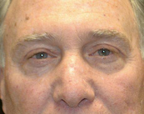 Blepharoplasty After, Male 56 - 1505